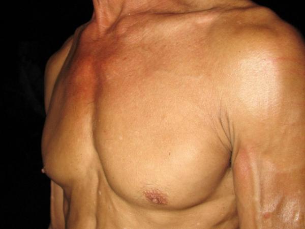 This is a close up photograph of my chest from the left side.